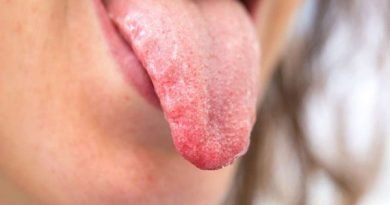 مراض الفم وعلاجها الصداف